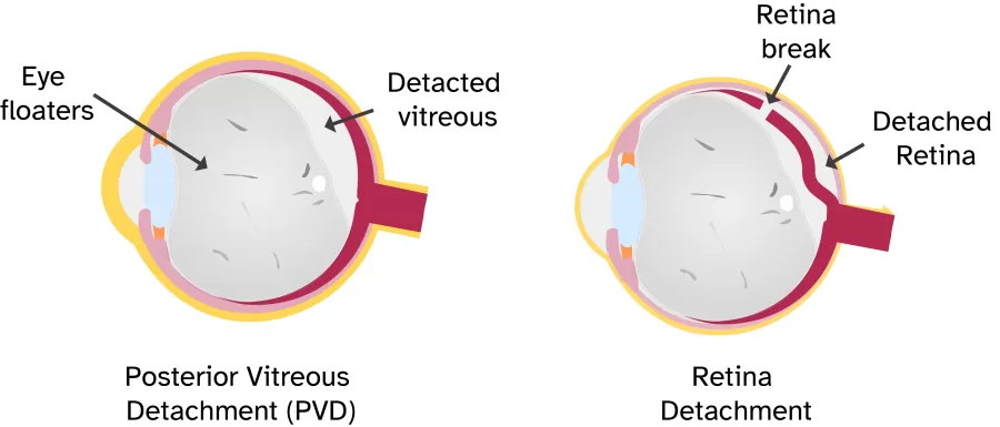Retinal Detachment And Eye Floaters Explained retinal-detachment-and-eye-floaters-explained